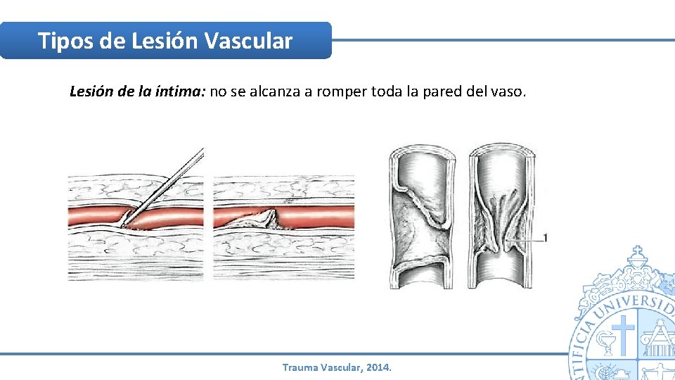 Tipos de Lesión Vascular Lesión de la íntima: no se alcanza a romper toda Tipos de Lesión Vascular Lesión de la íntima: no se alcanza a romper toda