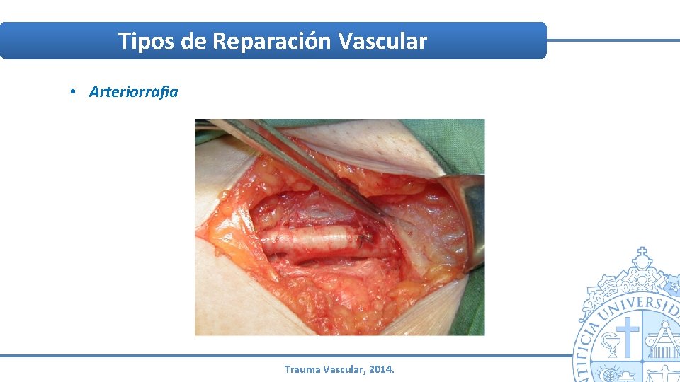 Tipos de Reparación Vascular • Arteriorrafia Trauma Vascular, 2014. Tipos de Reparación Vascular • Arteriorrafia Trauma Vascular, 2014.