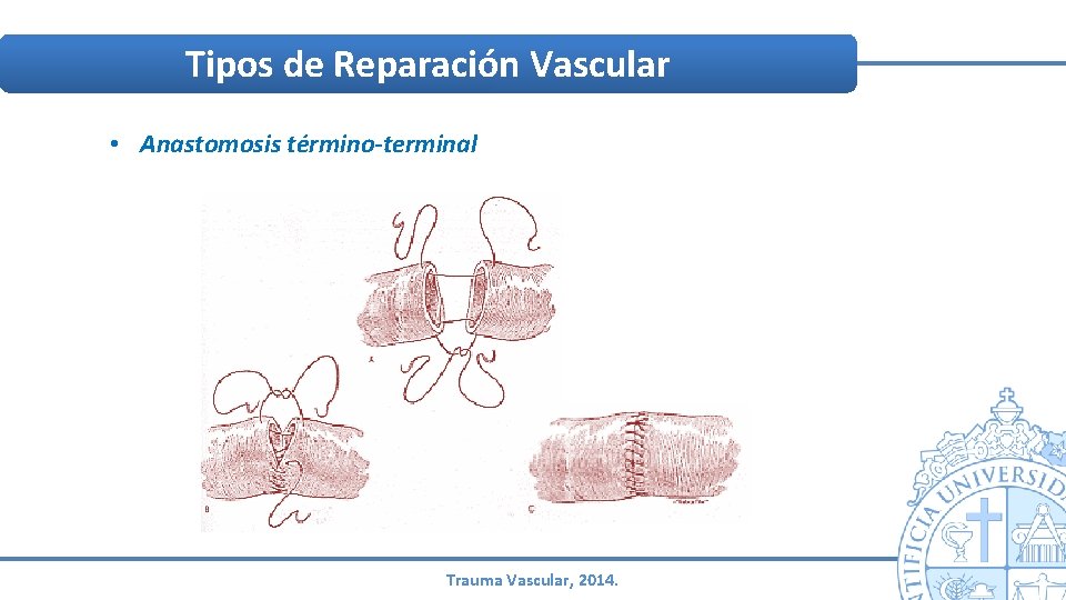 Tipos de Reparación Vascular • Anastomosis término-terminal Trauma Vascular, 2014. Tipos de Reparación Vascular • Anastomosis término-terminal Trauma Vascular, 2014.