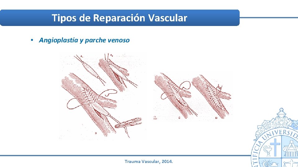 Tipos de Reparación Vascular • Angioplastía y parche venoso Trauma Vascular, 2014. Tipos de Reparación Vascular • Angioplastía y parche venoso Trauma Vascular, 2014.