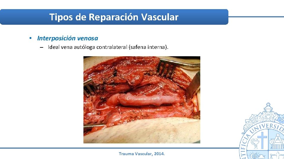 Tipos de Reparación Vascular • Interposición venosa – Ideal vena autóloga contralateral (safena interna). Tipos de Reparación Vascular • Interposición venosa – Ideal vena autóloga contralateral (safena interna).