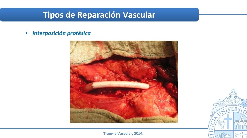 Tipos de Reparación Vascular • Interposición protésica Trauma Vascular, 2014. Tipos de Reparación Vascular • Interposición protésica Trauma Vascular, 2014.