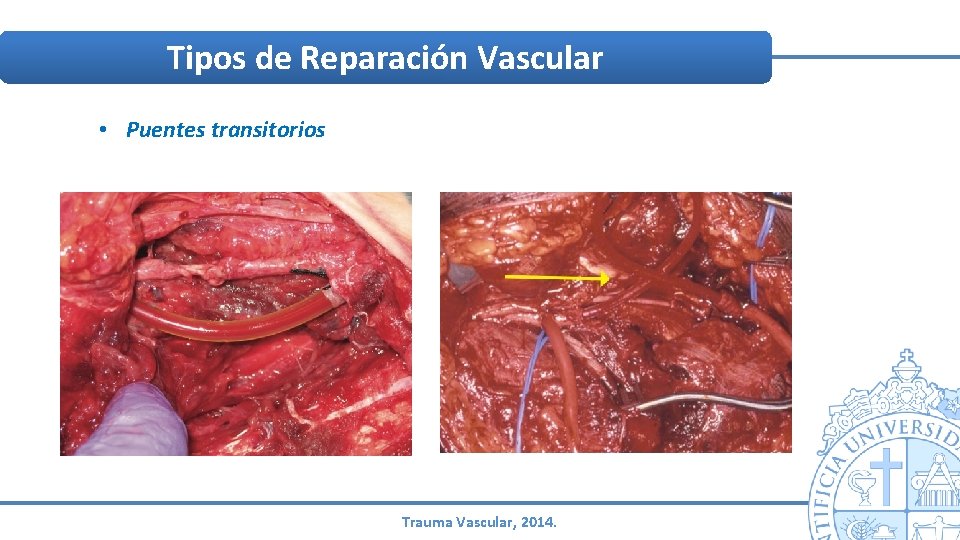 Tipos de Reparación Vascular • Puentes transitorios Trauma Vascular, 2014. Tipos de Reparación Vascular • Puentes transitorios Trauma Vascular, 2014.