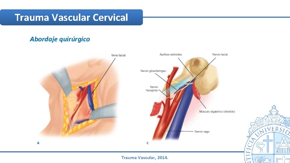 Trauma Vascular Cervical Abordaje quirúrgico Trauma Vascular, 2014. Trauma Vascular Cervical Abordaje quirúrgico Trauma Vascular, 2014.