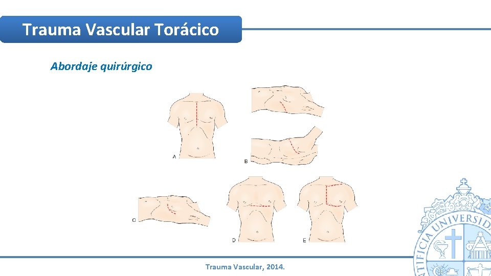 Trauma Vascular Torácico Abordaje quirúrgico Trauma Vascular, 2014. Trauma Vascular Torácico Abordaje quirúrgico Trauma Vascular, 2014.