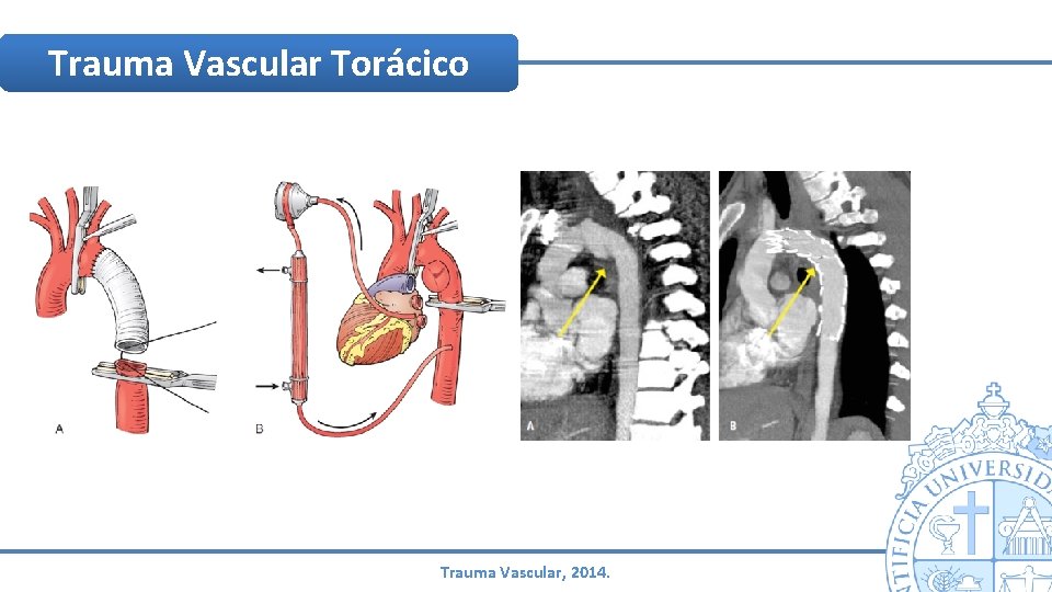 Trauma Vascular Torácico Trauma Vascular, 2014. Trauma Vascular Torácico Trauma Vascular, 2014.