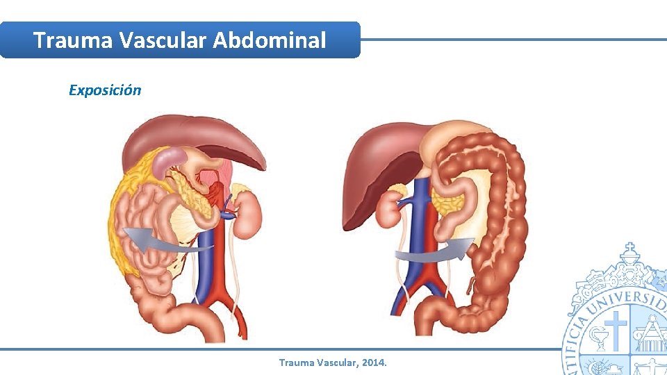 Trauma Vascular Abdominal Exposición Trauma Vascular, 2014. Trauma Vascular Abdominal Exposición Trauma Vascular, 2014.