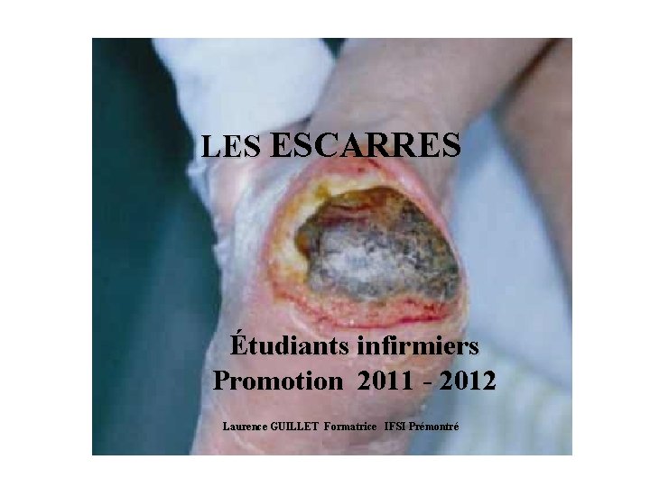 LES ESCARRES Étudiants infirmiers Promotion 2011 - 2012 Laurence GUILLET Formatrice IFSI Prémontré 