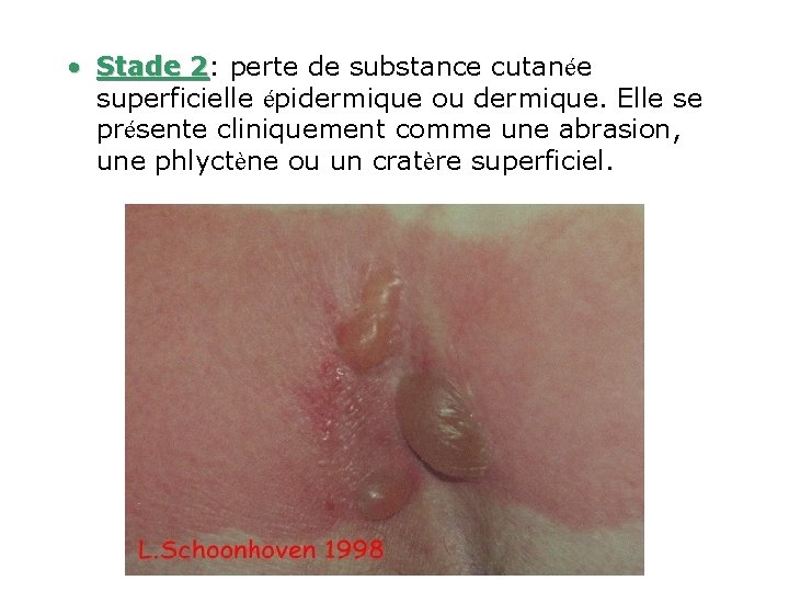  • Stade 2: 2 perte de substance cutanée superficielle épidermique ou dermique. Elle