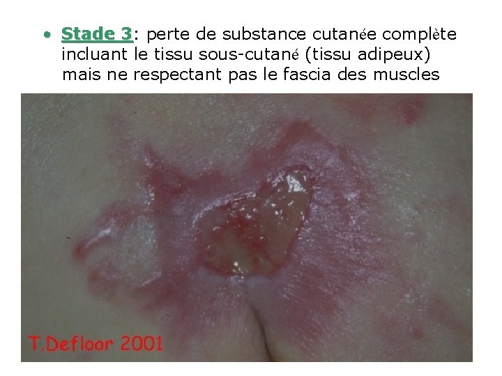  • Stade 3: 3 perte de substance cutanée complète incluant le tissu sous-cutané