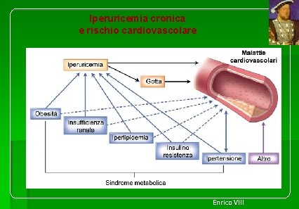 Iperuricemia cronica e rischio cardiovascolare Enrico VIII 