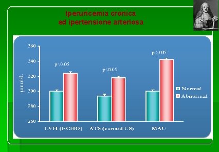 Iperuricemia cronica ed ipertensione arteriosa 