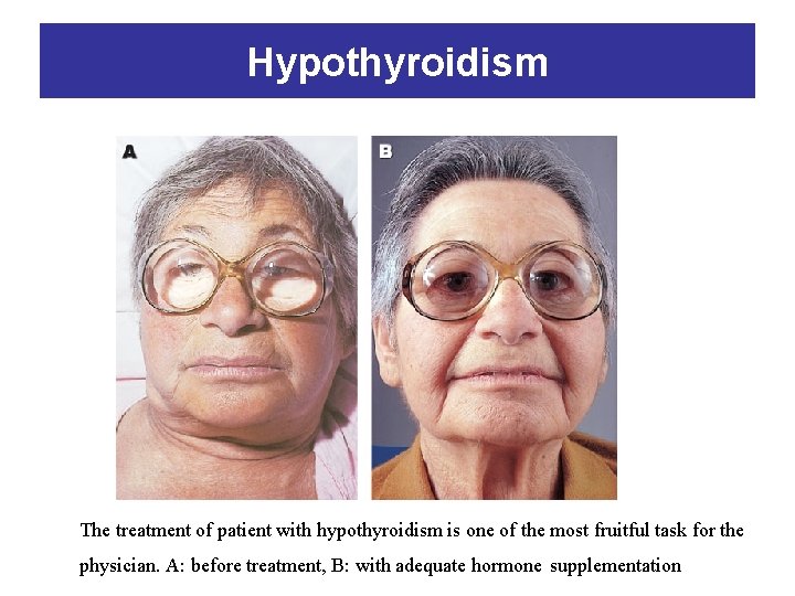 Hypothyroidism The treatment of patient with hypothyroidism is one of the most fruitful task