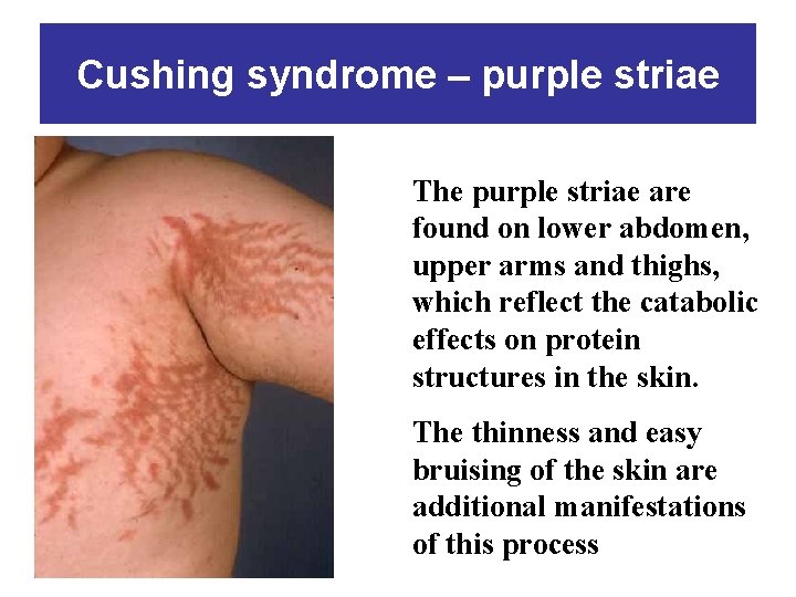Cushing syndrome – purple striae The purple striae are found on lower abdomen, upper