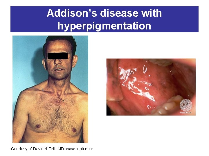 Addison’s disease with hyperpigmentation Courtesy of David N Orth MD. www. uptodate 