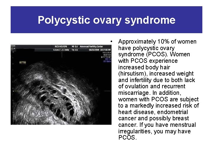 Polycystic ovary syndrome • Approximately 10% of women have polycystic ovary syndrome (PCOS). Women