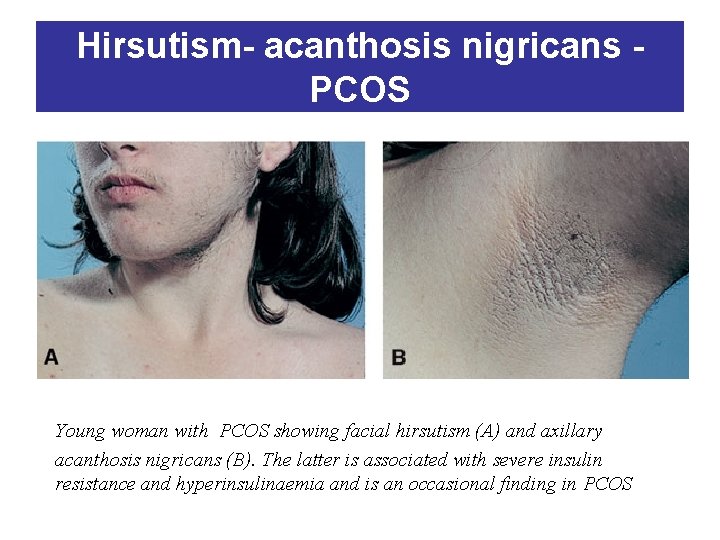 Hirsutism- acanthosis nigricans PCOS Young woman with PCOS showing facial hirsutism (A) and axillary