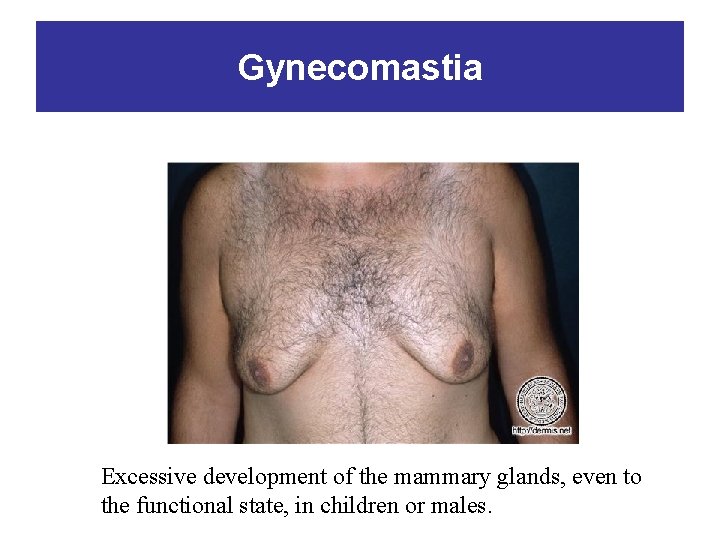 Gynecomastia Excessive development of the mammary glands, even to the functional state, in children