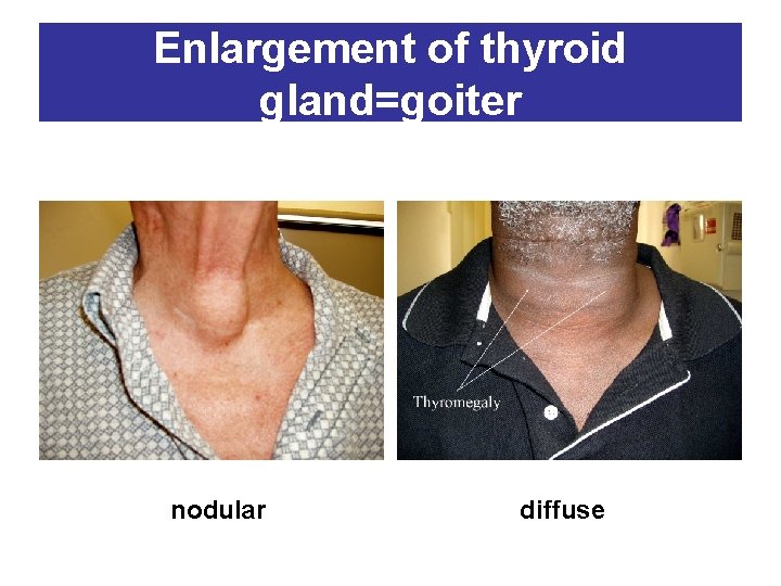 Enlargement of thyroid gland=goiter nodular diffuse 