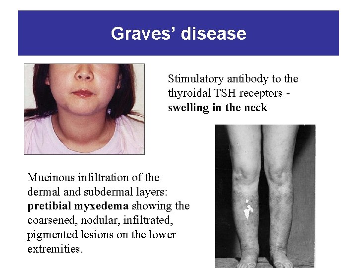 Graves’ disease Stimulatory antibody to the thyroidal TSH receptors swelling in the neck Mucinous