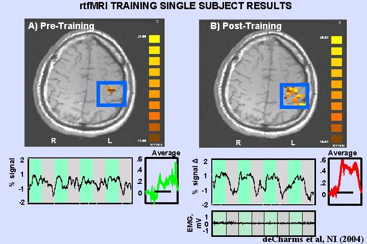 rtf. MRI TRAINING SINGLE SUBJECT RESULTS B) Post-Training A) Pre-Training 1 -1 -2 R. rtf. MRI TRAINING SINGLE SUBJECT RESULTS B) Post-Training A) Pre-Training 1 -1 -2 R.