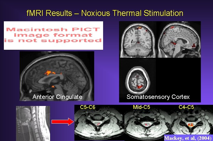 f. MRI Results – Noxious Thermal Stimulation Anterior Cingulate C 5 -C 6 Somatosensory f. MRI Results – Noxious Thermal Stimulation Anterior Cingulate C 5 -C 6 Somatosensory