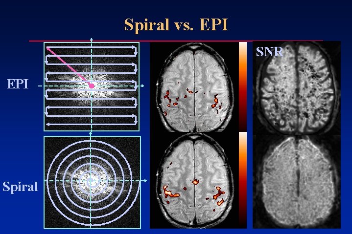 Spiral vs. EPI SNR EPI Spiral Spiral vs. EPI SNR EPI Spiral