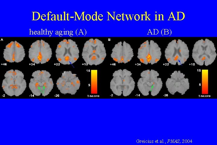Default-Mode Network in AD healthy aging (A) AD (B) Greicius et al. , PNAS, Default-Mode Network in AD healthy aging (A) AD (B) Greicius et al. , PNAS,