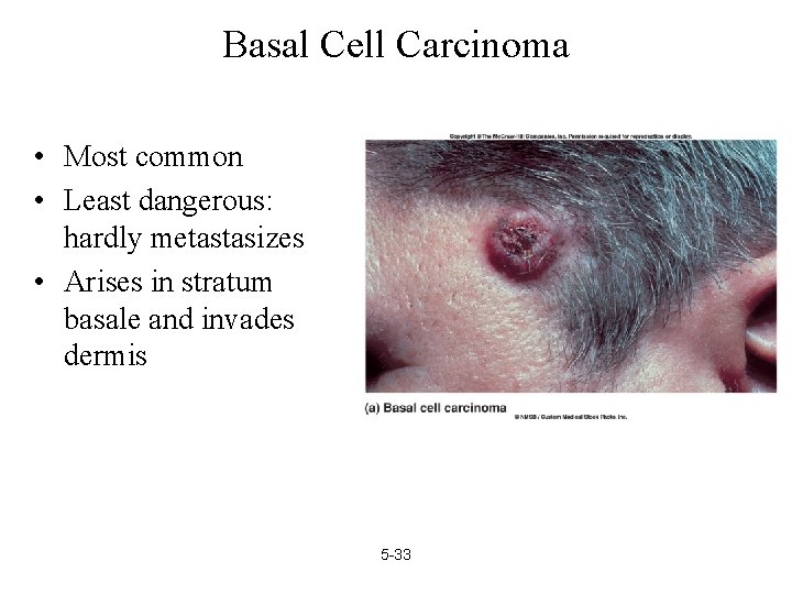 Basal Cell Carcinoma • Most common • Least dangerous: hardly metastasizes • Arises in
