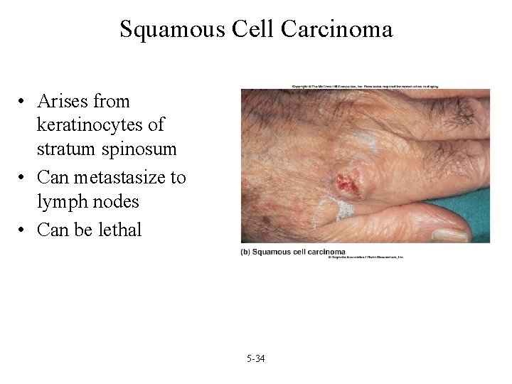 Squamous Cell Carcinoma • Arises from keratinocytes of stratum spinosum • Can metastasize to