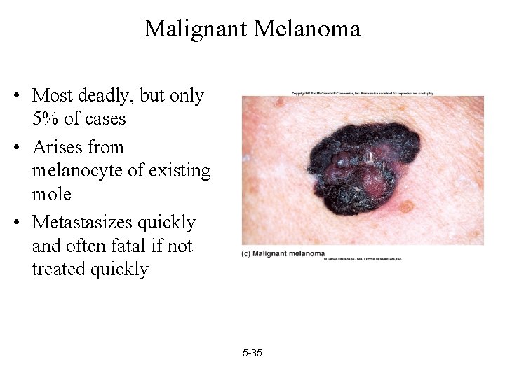 Malignant Melanoma • Most deadly, but only 5% of cases • Arises from melanocyte