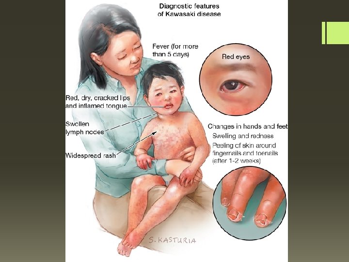 håndbevægelse kerne film Kawasaki Disease June 29 2015 Intern Kittipos Wongnisanatakul