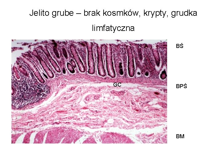 Jelito grube – brak kosmków, krypty, grudka limfatyczna BŚ GC BPŚ BM 