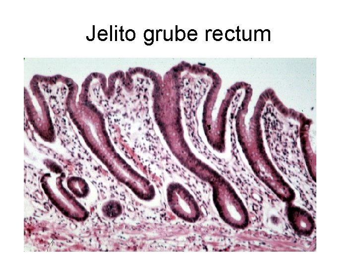 Jelito grube rectum 