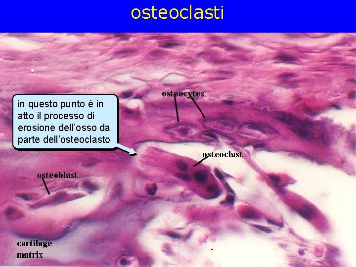 osteoclasti in questo punto è in atto il processo di erosione dell’osso da parte