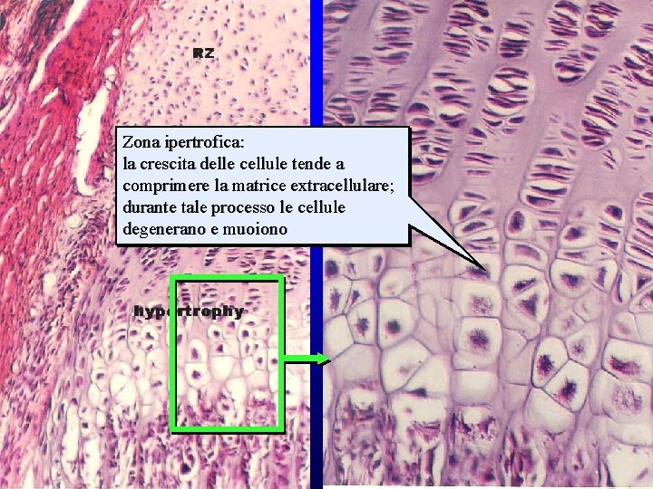 strati della cartilagine di accrescimento (2) Zona ipertrofica: la crescita delle cellule tende a