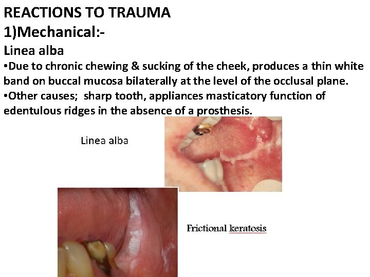 REACTIONS TO TRAUMA 1)Mechanical: Linea alba • Due to chronic chewing & sucking of