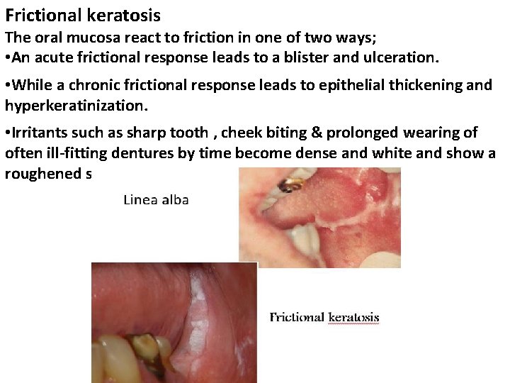 Frictional keratosis The oral mucosa react to friction in one of two ways; •
