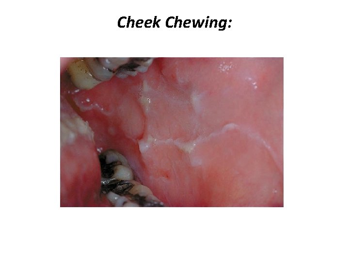 Cheek Chewing: 