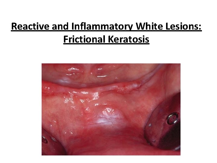 Reactive and Inflammatory White Lesions: Frictional Keratosis 