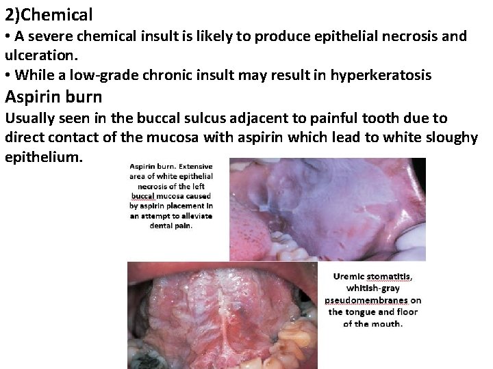 2)Chemical • A severe chemical insult is likely to produce epithelial necrosis and ulceration.
