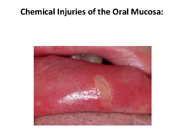 Chemical Injuries of the Oral Mucosa: 