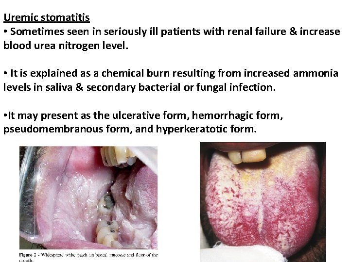 Uremic stomatitis • Sometimes seen in seriously ill patients with renal failure & increase