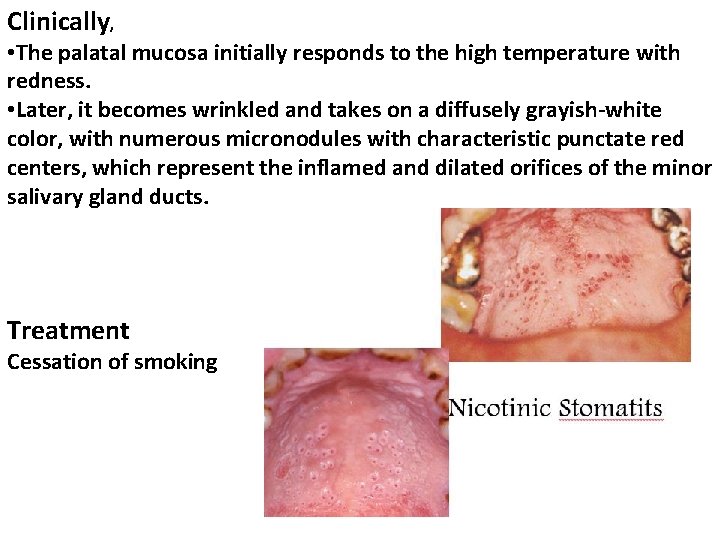 Clinically, • The palatal mucosa initially responds to the high temperature with redness. •