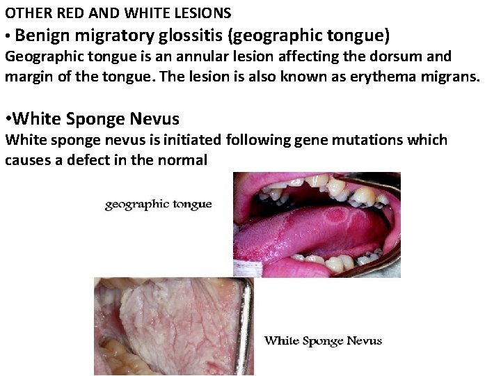 OTHER RED AND WHITE LESIONS • Benign migratory glossitis (geographic tongue) Geographic tongue is