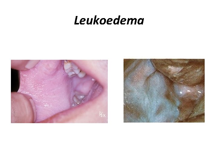 Leukoedema 