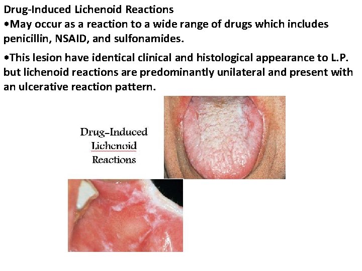Drug-Induced Lichenoid Reactions • May occur as a reaction to a wide range of