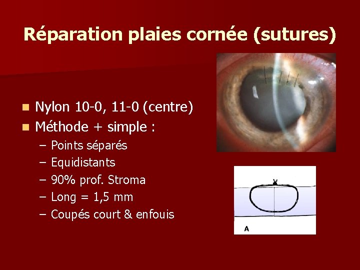 Réparation plaies cornée (sutures) Nylon 10 -0, 11 -0 (centre) n Méthode + simple