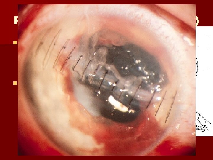 Réparation plaies cornée (sutures) n Plaie passant par l’axe visuel : – Sutures de