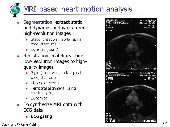 MRI-based heart motion analysis n Segmentation: extract static and dynamic landmarks from high-resolution images